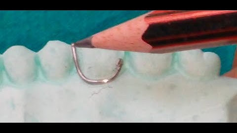 circumferential clasp or c clasp