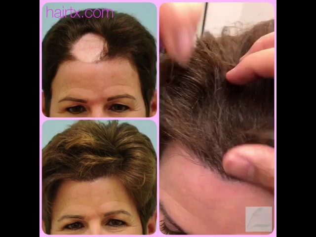 Dallas Hair Scar Repair Hair Transplant Video and Photos