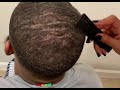 FLAKE FRENZY! Satisfying scalp scratch