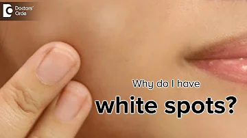 What is the cause of white spots on the skin? - Dr. Rasya Dixit