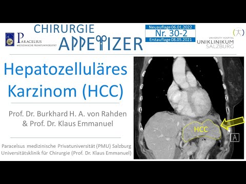 Hepatozelluäres Karzinom (HCC) CHIRURGIE APPetizer Nr. 30-2 (NEUAUFLAGE)