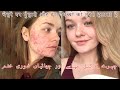 Homeopathic medicine for acne| मुँहासे के निशान अब गायब हो गए हैं! Best medicine for female face
