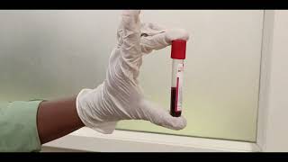 Mastering Blood Sample Collection: Step-by-Step Guide and Pro Tips for Phlebotomy or Venepuncture