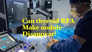 How do smaller thyroids nodule respond to Thyroid RFA, by Sean Nikravan, MD