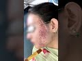 Chemical peel treatment for acne  pimples treatment  skinaa clinic viral skinaaclinic shorts