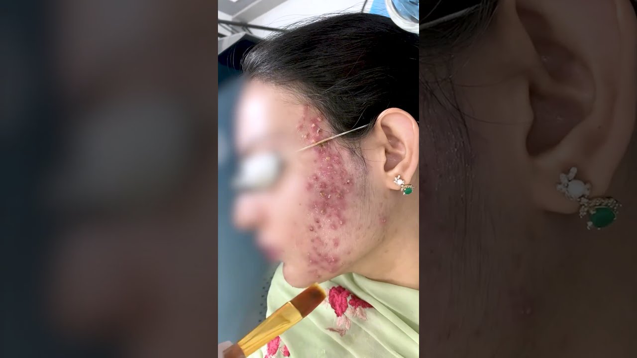 Chemical Peel Treatment For Acne Pimples Skinaa Clinic Viral Shorts