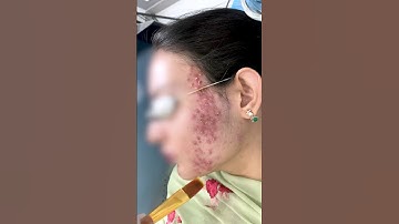 Thumbnail of chemical peel treatment for acne | Pimples Treatment | Skinaa Clinic #viral #skinaa_clinic #shorts