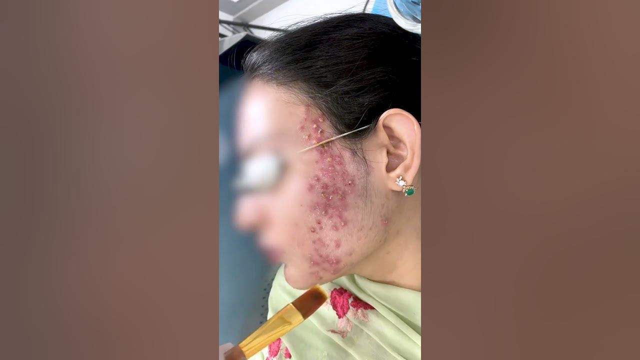 chemical peel treatment for acne | Pimples Treatment | Skinaa Clinic #viral #skinaa_clinic #shorts