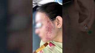 Chemical Peel Treatment For Acne Pimples Treatment Skinaa Clinic 