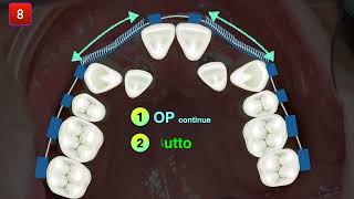 Pseudo class III with severe crowding｜【Chris Chang Ortho】CC635