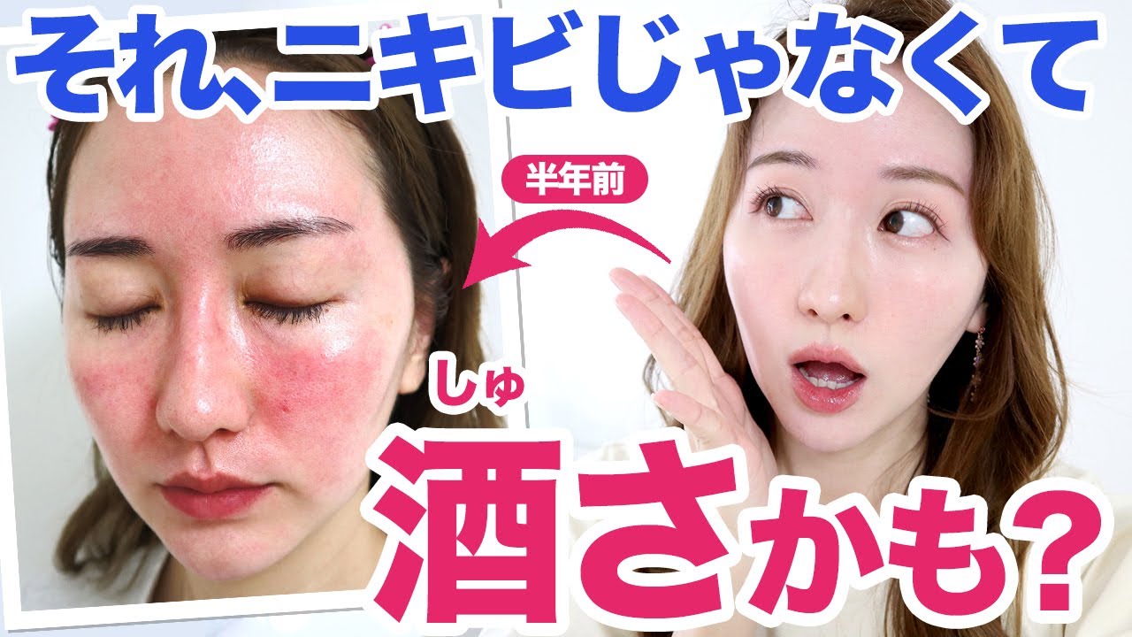 肌荒れと何が違う 酒さって何それ ニキビとの違いを酒さ患者が語ります 酒さ体験談 Youtube 肌荒れと何が違う 酒さって何それ ニキビとの違いを酒さ患者が語ります 酒さ体験談 Youtube