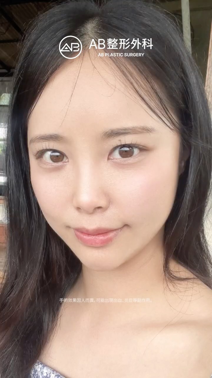 眼整形一個月變化超驚人✨ #Shorts
