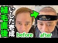 【体験談】いしだ壱成さんの植毛直後の感想【植毛大使|治療|薄毛の窓口】