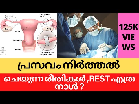 POSTPARTUM STERILIZATION Malayalam