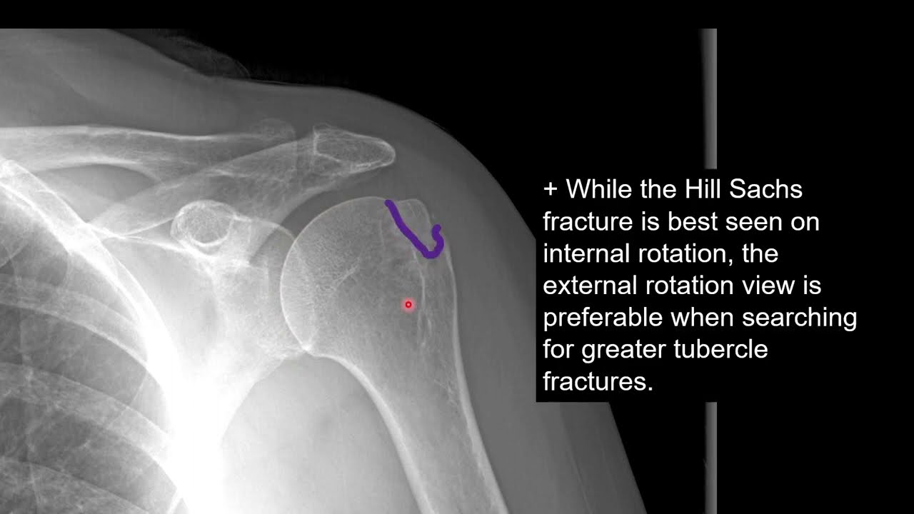 Shoulder X Ray Trauma Proximal Humeral Head Fractures And AC Joint Shoulder X Ray Trauma Proximal Humeral Head Fractures And AC Joint