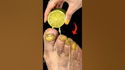 Get rid of fungus forever with lime! A doctor shared this simple recipe with me!