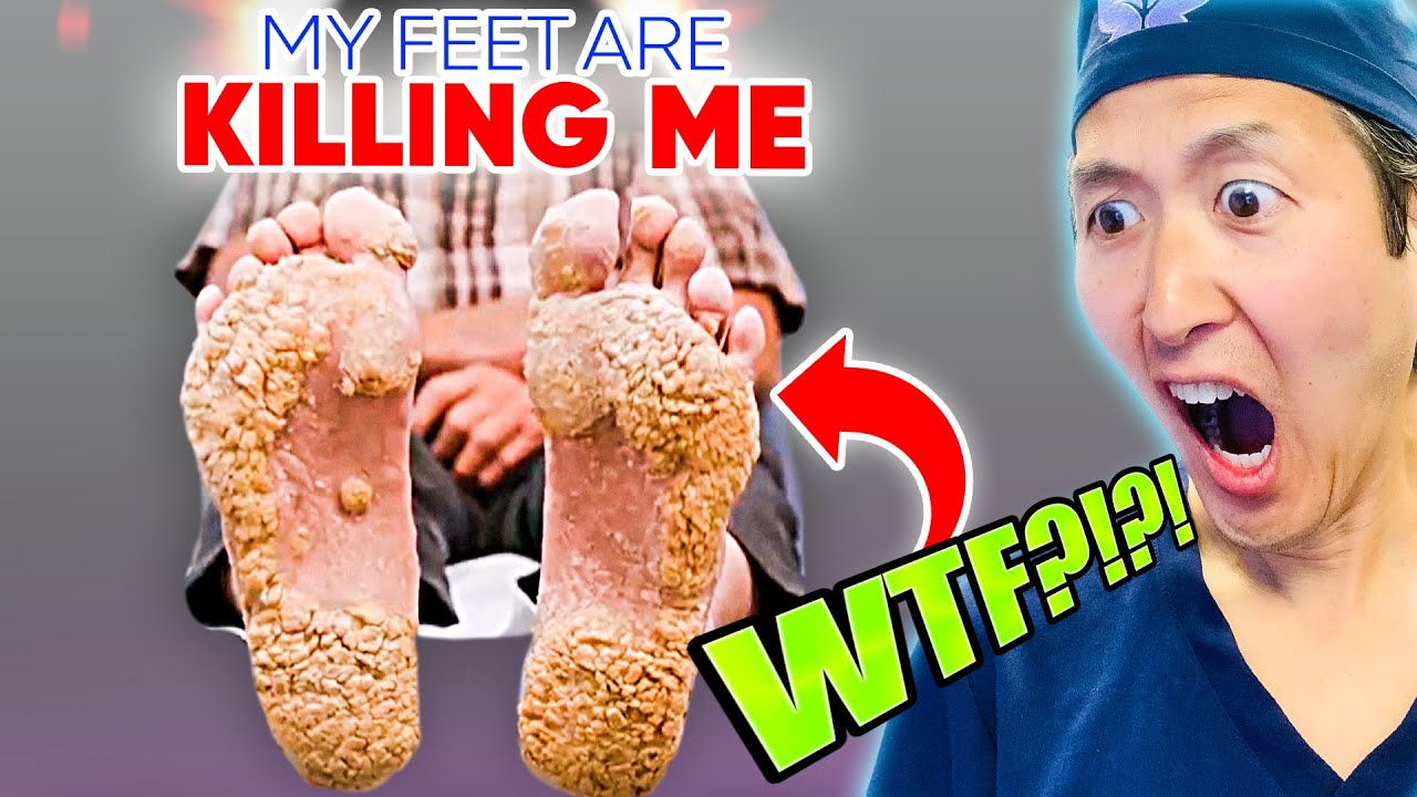Plastic Surgeon Reacts to MY FEET ARE KILLING ME! EXTREME Growths + EXTREME Treatment!