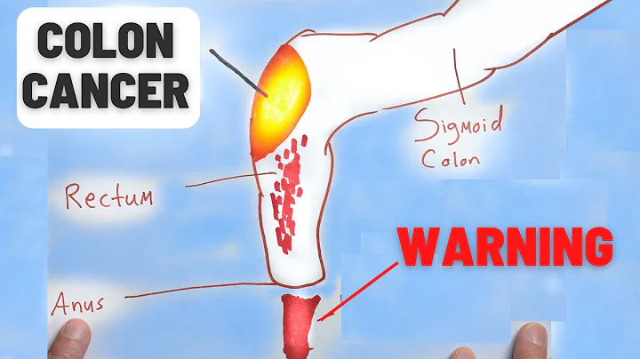 4 Warning Signs of Colon Cancer You Should NEVER Ignore - DayDayNews