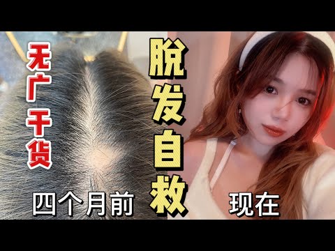 大厂程序媛四个月脱发自救记录｜米诺地尔
