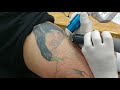 Remoção de Tattoo a Laser parte/1(1)