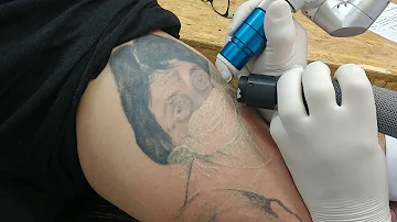 Como tirar a tatuagem com laser?