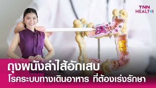 “โรคถุงผนังลำไส้อักเสบ”ปัญหาระบบทางเดินอาหาร ที่ต้องเร่งแก้ไข : TNN Health