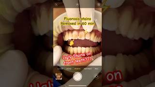 Permanent fluorosis stains on teeth can be removed #dentist #tech #yourbody #digital #fluorosis #gym Permanent fluorosis stains on teeth can be removed #dentist #tech #yourbody #digital #fluorosis #gym