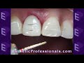 Porcelain Veneers- Preparation Techniques #1