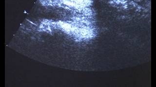 ECBv Ch 17 Aorta 3 AMI
