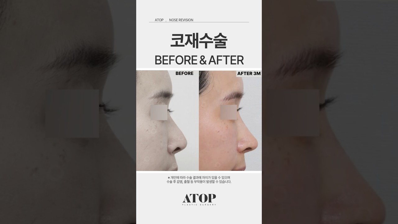 [ЭЙТАП гоо сайхны эмнэлэг] Хамрын давтан мэс заслын жинхэнэ сэтгэгдэл #Ганнамгоосайхныэмнэлэг #Гоосайхныэмнэлэг #Хамрынгоосайхнымэсзасалсайнхийдэггазар