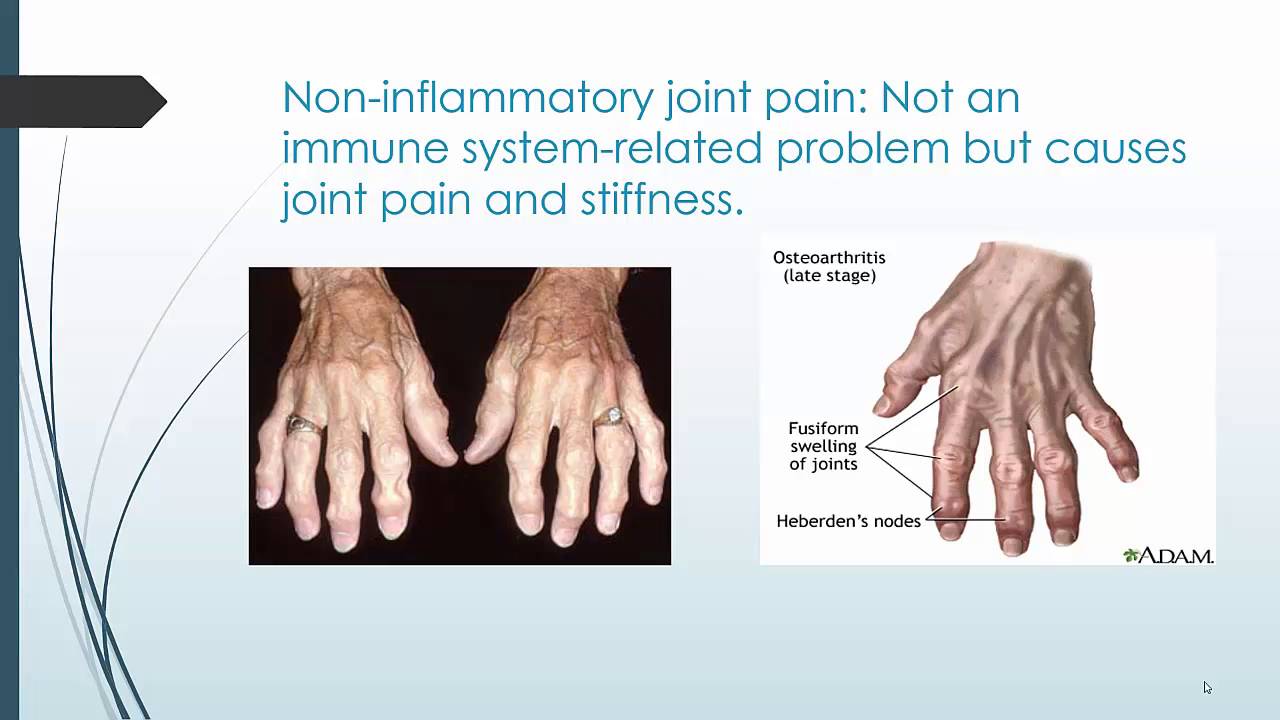 Managing the Symptoms of your Arthritic Condition YouTube