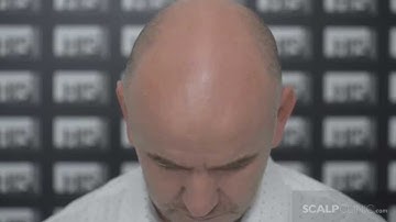 Hair Loss Treatment for Men - Scalp Micropigmentation at Scalp Clinic