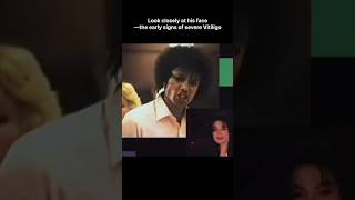 Rare Michael Jackson Vitiligo Clip | Showing His True Condition