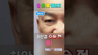 하안검수술 후 찡그려 보았습니다.