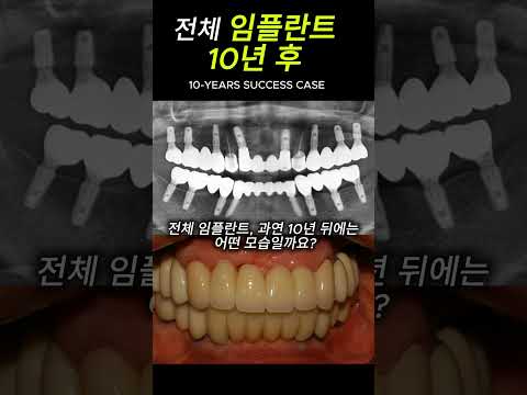 🦷 전체 임플란트 10년 후의 진짜 모습 (성공의 정석)