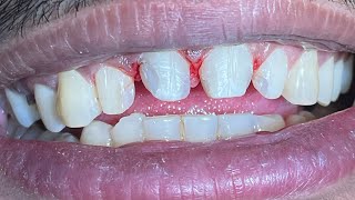 Digital intraoral scanning for Zirconia smile makeover | Delhi 5 dental clinic | Raw full video 🚨