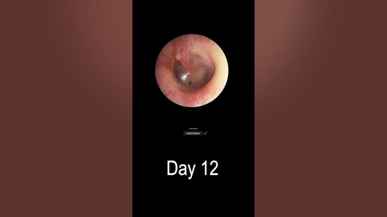 How hole in your eardrum heals timelapse youtube