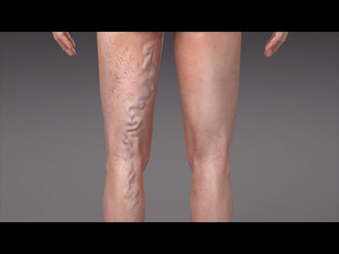 Varicose Veins کیا ہیں؟