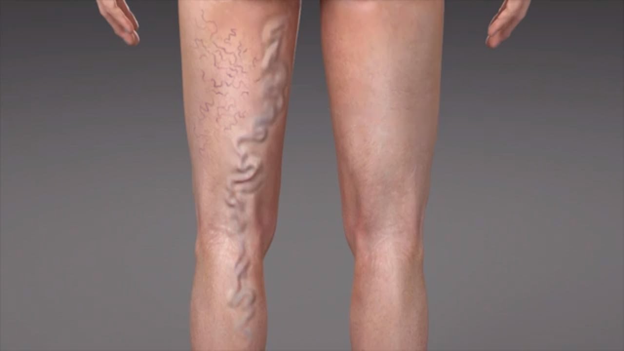 What are Varicose Veins? - YouTube