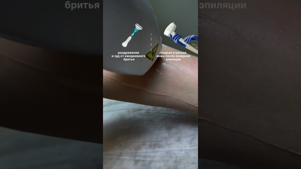 Лазерная эпиляция VS Бритва?