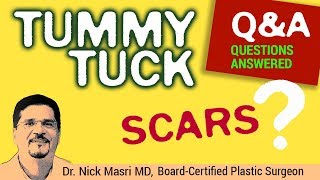 Tummy Tuck Scars ❓(Question Answered) ✅