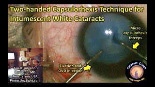 two-handed capsulorhexis technique for intumescent white cataracts