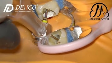 Denco “Chameleon” Rotary Files | Manualless management of Severely Obliterated Canals of Lower Molar