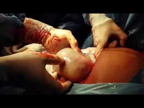 Delivery through CS (C-section)