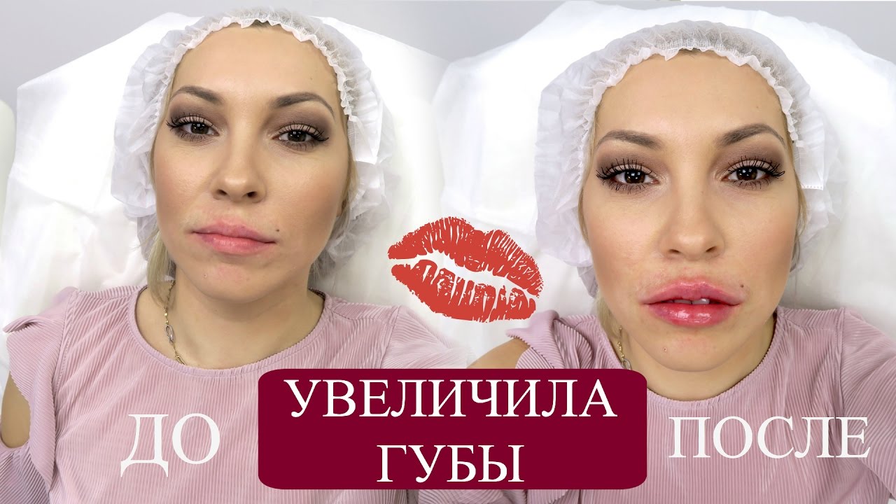 фото губы до и после онлайн фото губы до и после