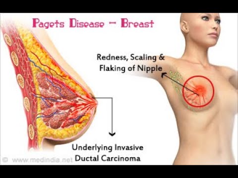 Paget’s disease of nipple