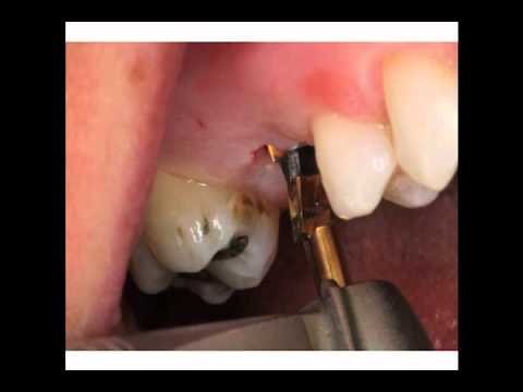 Digital Implant Treatment Planning and Restoration of Maxillary Posterior Single Teeth (Part 3 of 4)