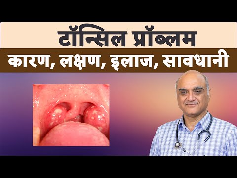 Tonsillitis। Tonsil infection। टॉन्सिल। बच्चों के गले में टॉन्सिल । Dr. Rajive Bhatia