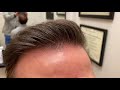 Dallas Hair Transplant CloseUp/Testimonial/Photos