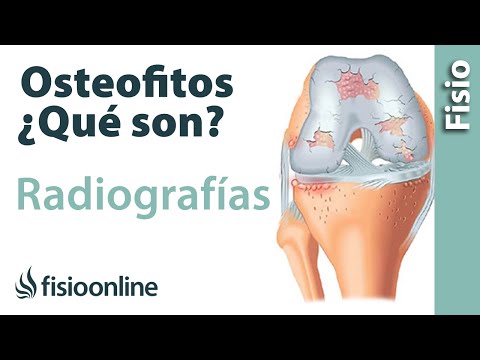 Video: ¿Qué es el osteofito discal?